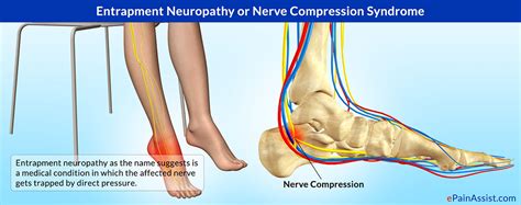 nerve entrapment heel surgery